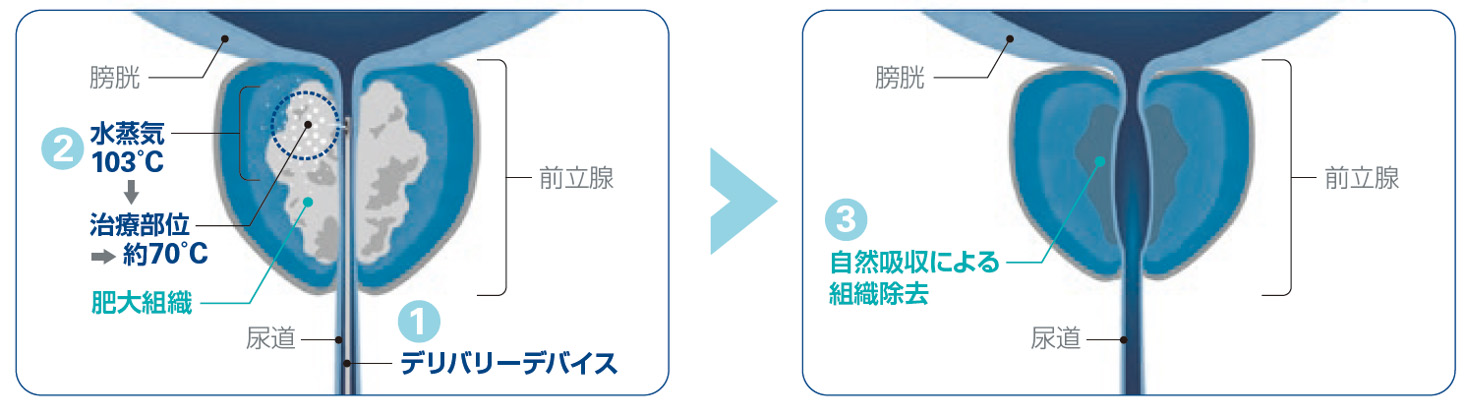 WAVE治療の仕組み